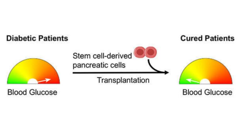 Stem Cell Therapy for Diabetes in India: A Promising Breakthrough